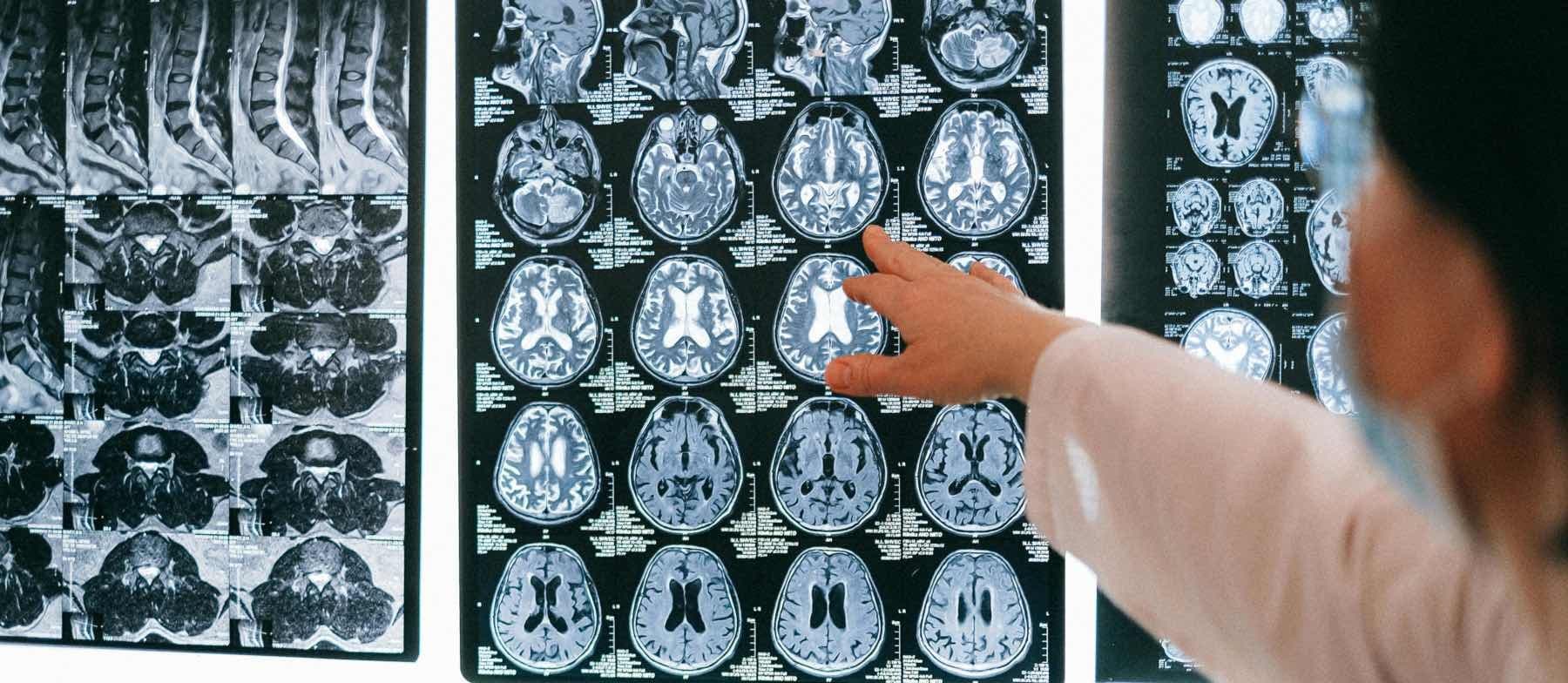 Huntington’s: A Journey into the Depth of a Neurological Disease